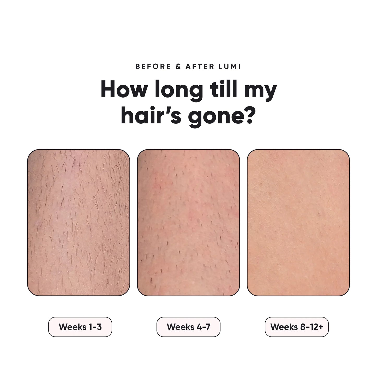 Ultimate Hair Removal Solution